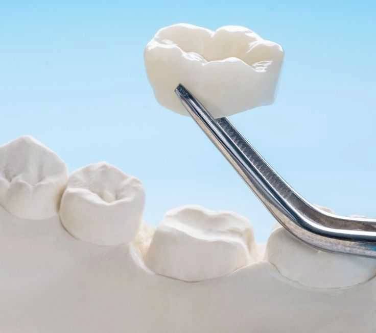 Dental Crown