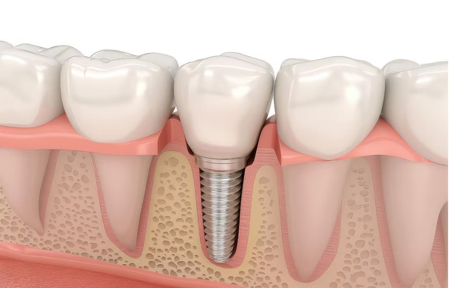 Implants