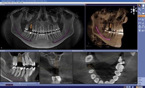 Implants