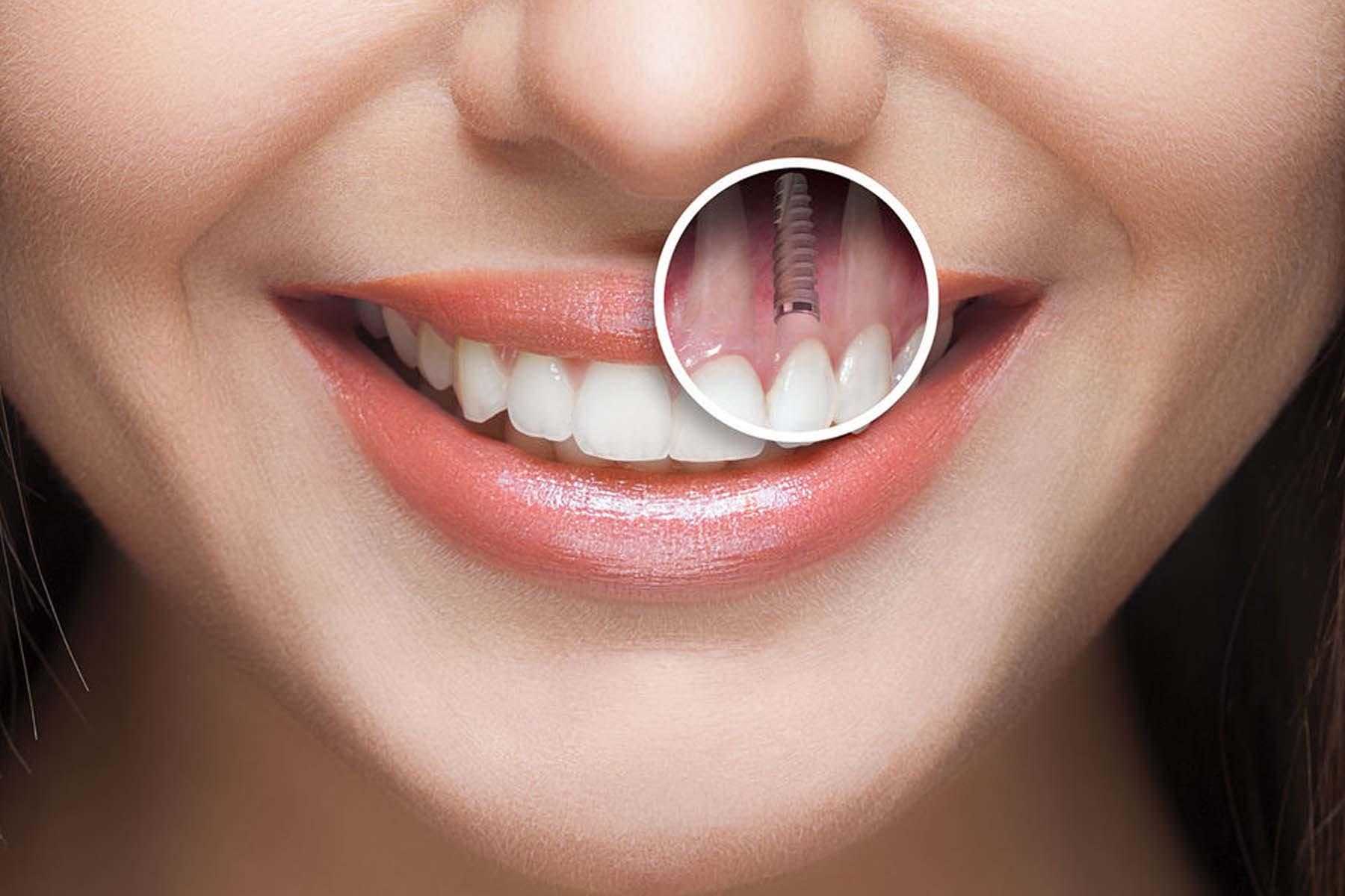 Implants