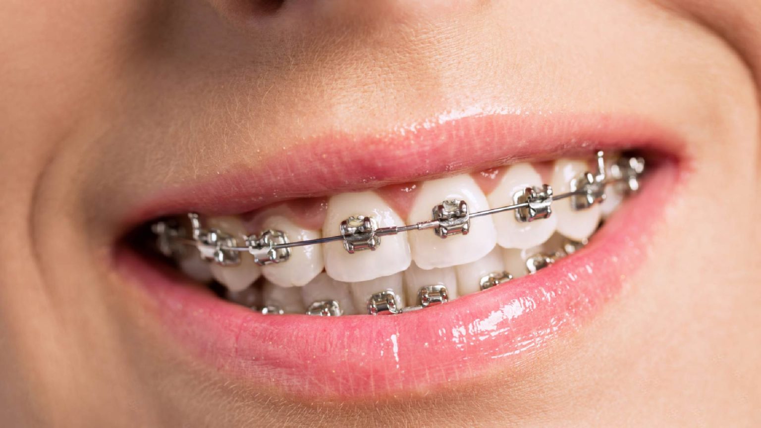 Orthodontic