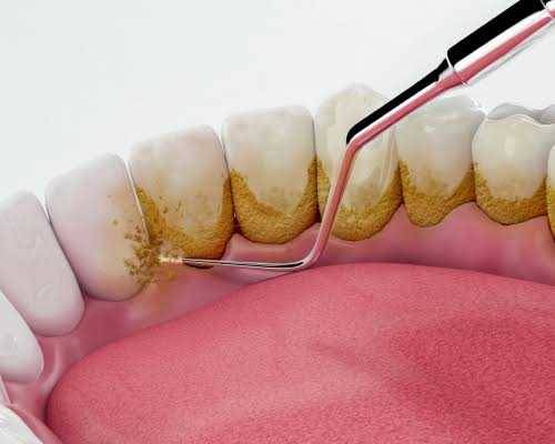 Periodontic