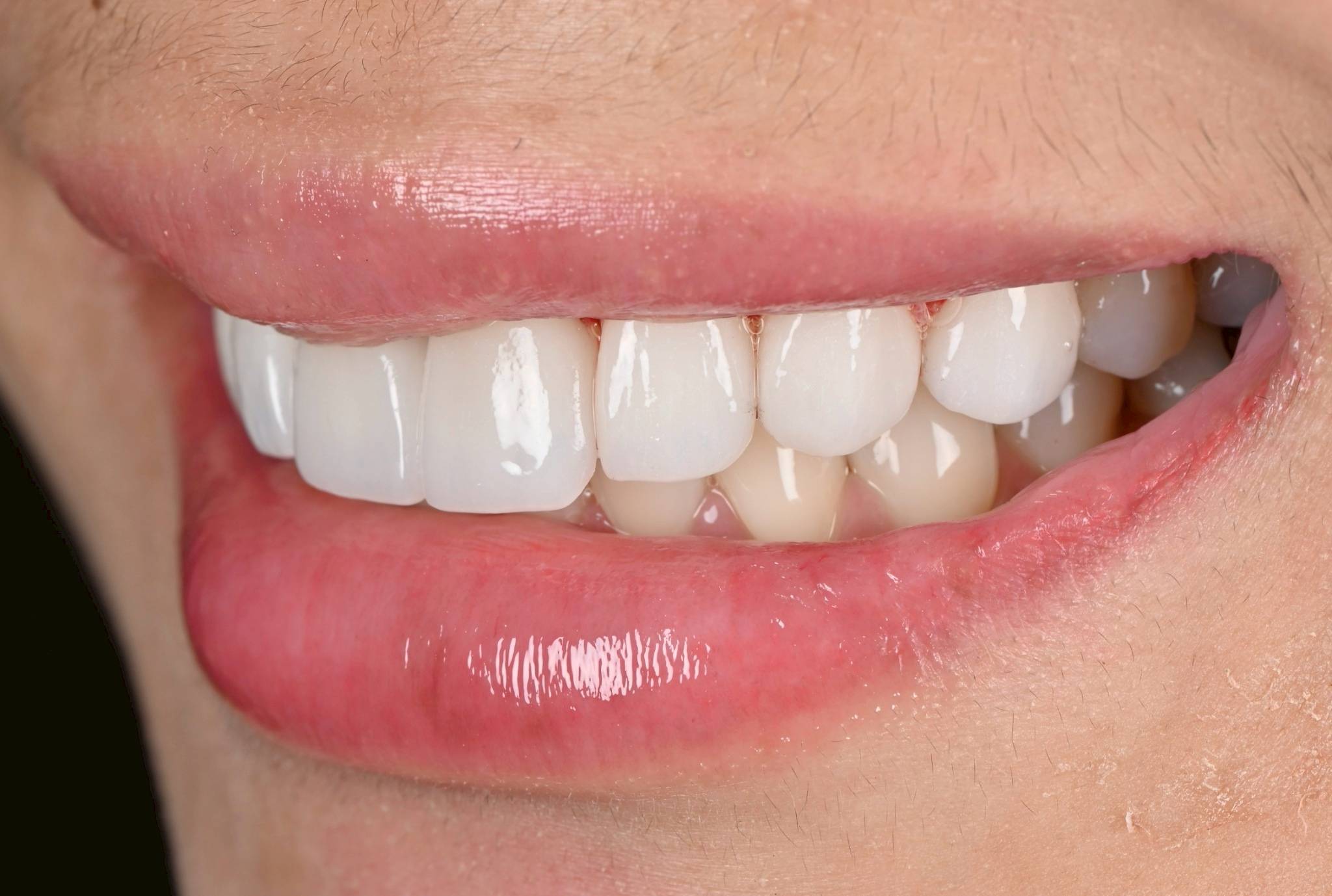 Veneer