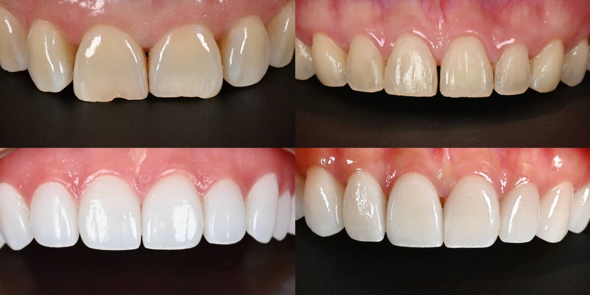 Veneer