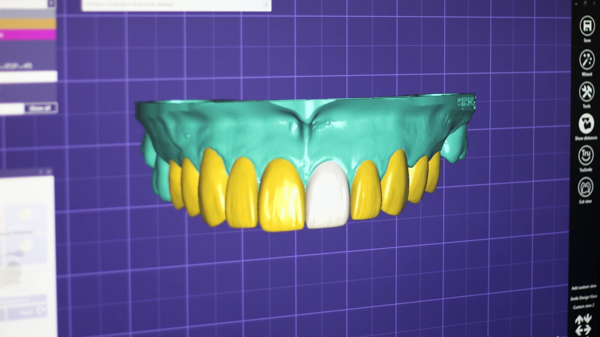 Veneer