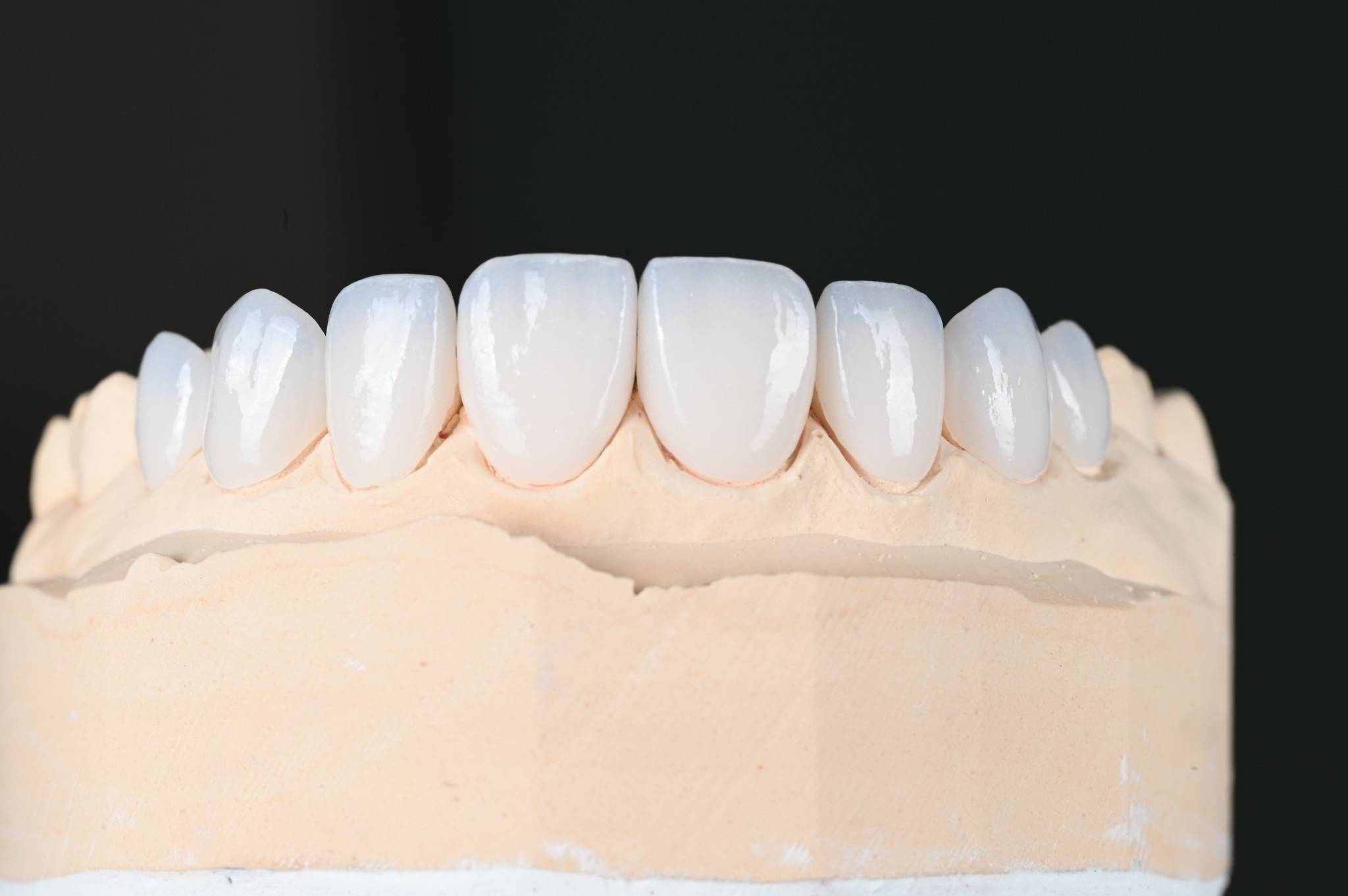 Veneer