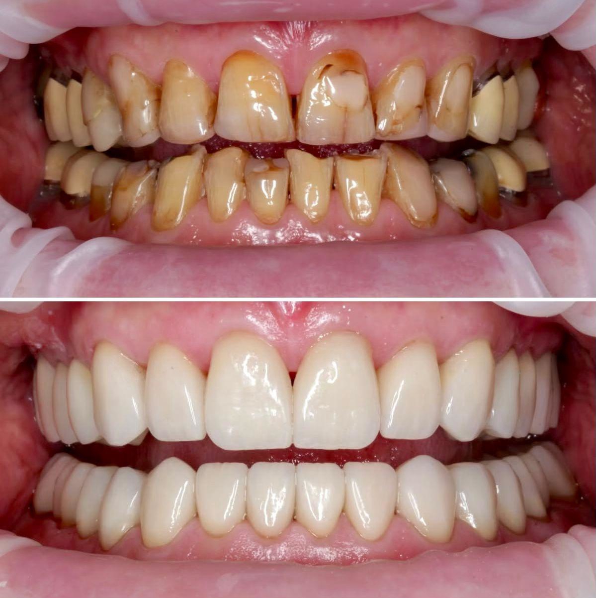 全口重建治疗前后对比案例