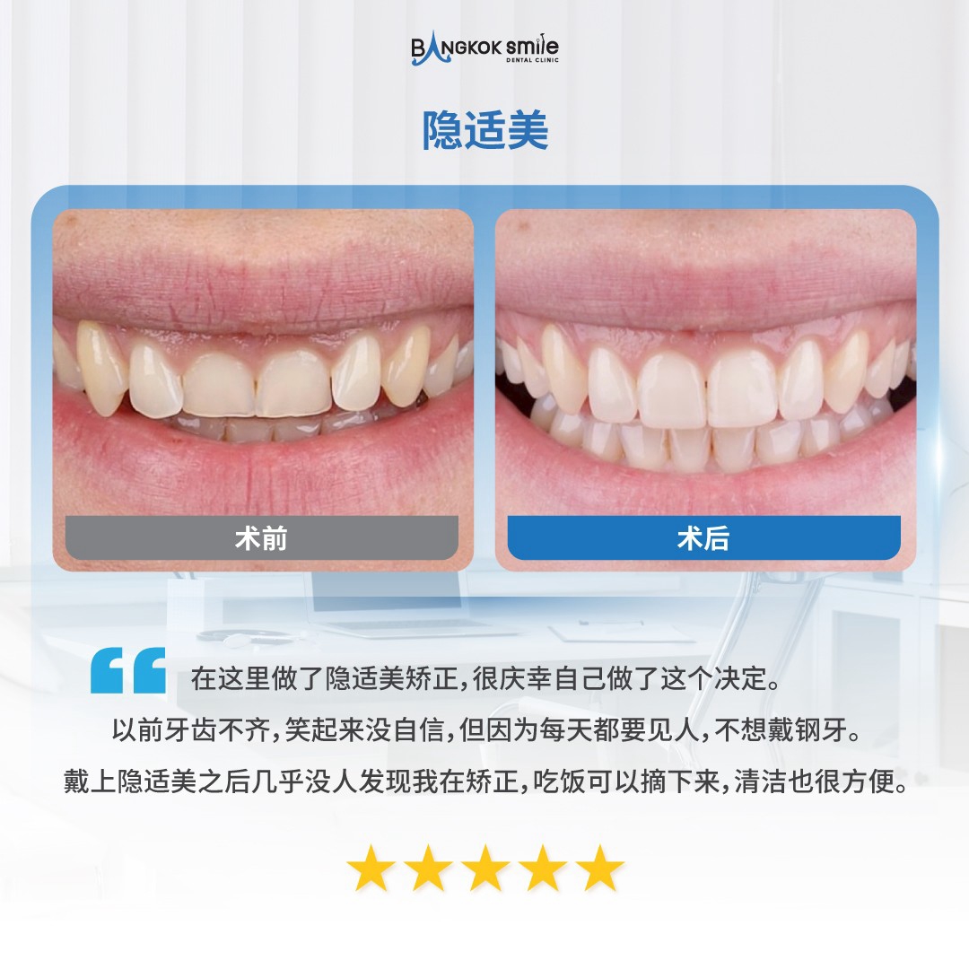 隐适美正畸 + 冷光美白