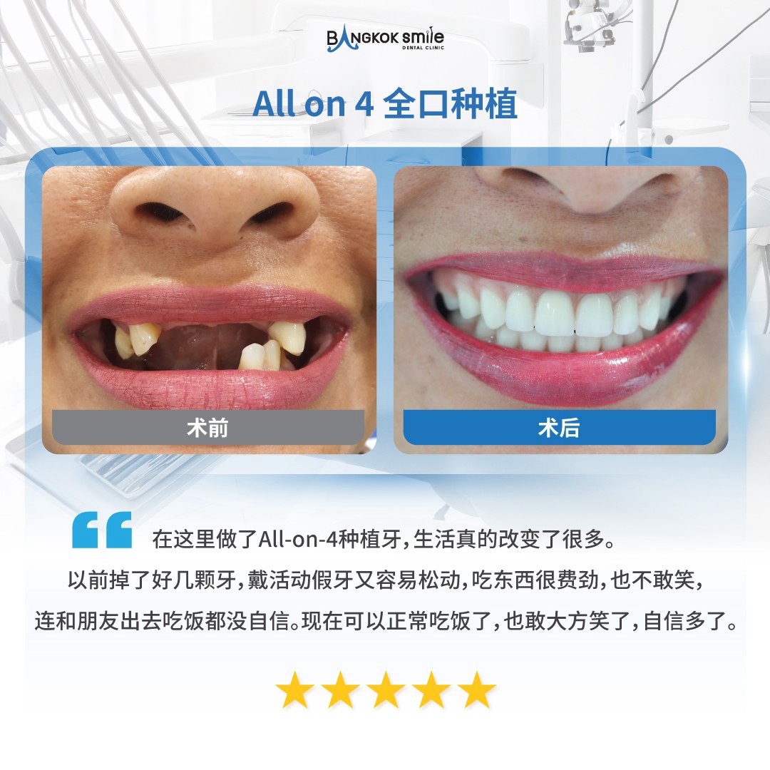 All-on-4 全口种植修复