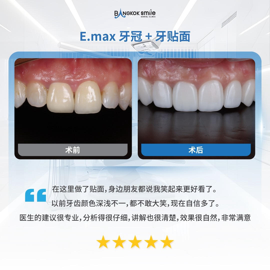全瓷冠美学修复