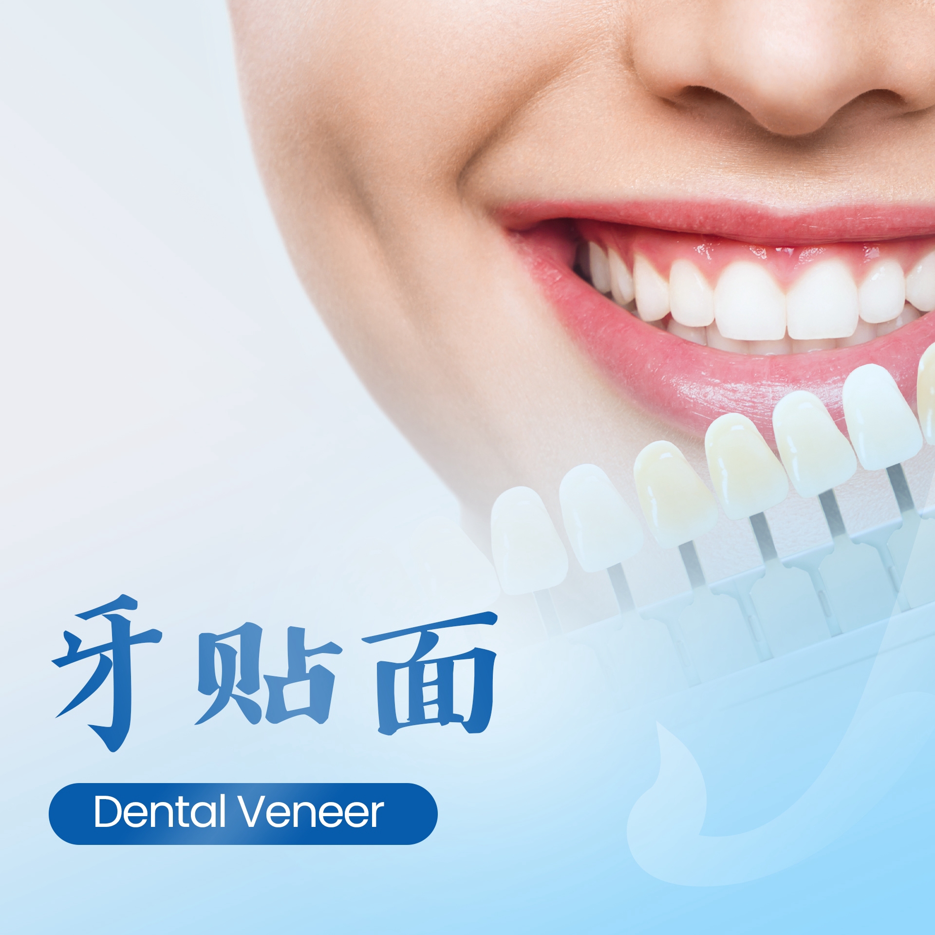 牙贴面 Dental Veneer
