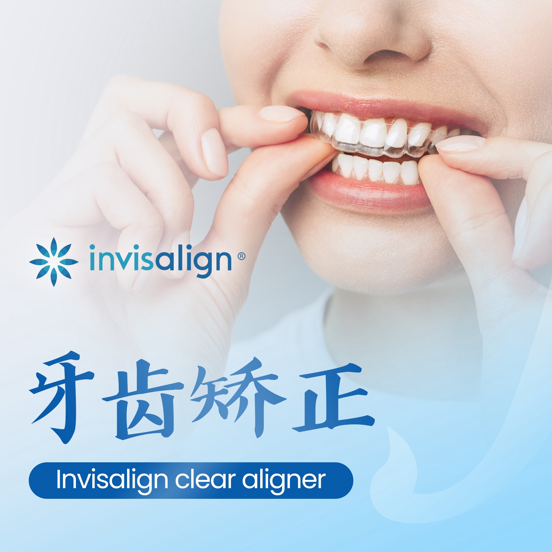 牙齿矫正 Invisalign clear aligner