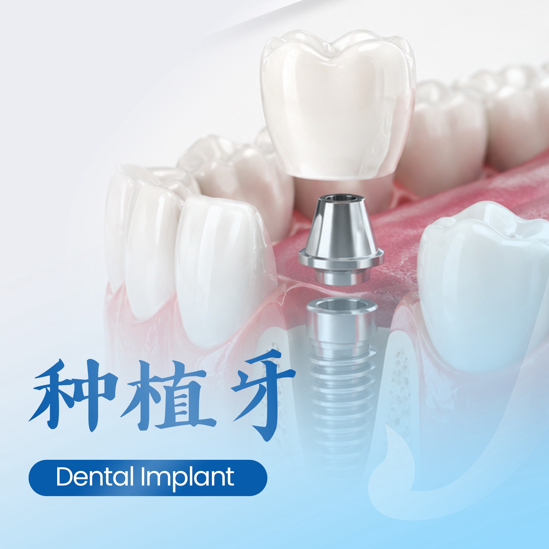 种植牙 Dental Implant